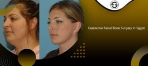 Corrective Facial Bone Surgery in Egypt